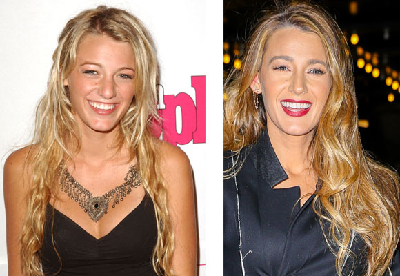 Blake Lively rinoplastia